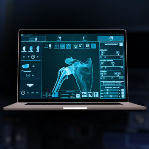 Exactech Shoulder Equinoxe Planning App Active Intelligence